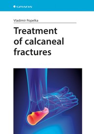 E-kniha Treatment of calcaneal fractures